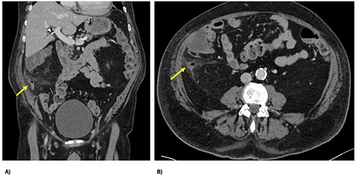 Computed tomography slices showing perforated appendicitis, post-embolization.