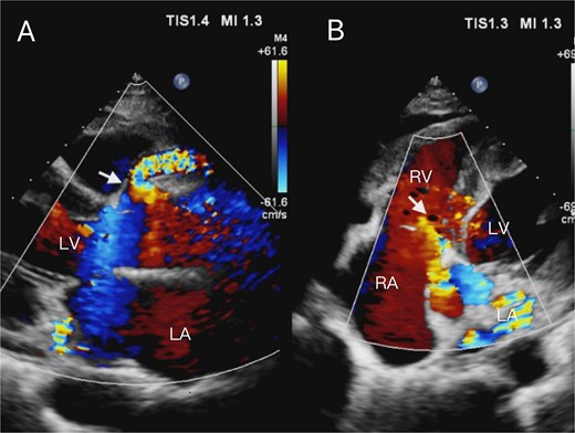 Transthoracic echocardiogram. (A) The parasternal long-axis view demonstrates aneurysmal dilation of the right coronary artery, with the proximal segment dilated to ~9 mm in diameter. Color Doppler echocardiography demonstrates turbulent flow within the dilated coronary artery segment(arrow). (B) The apical five-chamber view demonstrates the right atrium and right ventricle under color Doppler echocardiography. Color Doppler echocardiography reveals turbulent flow originating superior to the tricuspid septal leaflet, oriented toward the right atrium, with an associated perforation measuring ~5.8 mm in diameter (arrow).