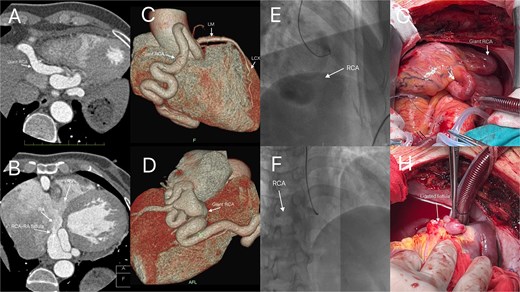 Enhanced CT coronary angiography confirmed the presence of a right coronary artery to right atrium fistula with a giant right coronary artery (A, B, arrows). Three-dimensional reconstruction (C, D, arrows) and selective coronary angiography further confirmed these findings (E, F, arrows). Intraoperative photograph clearly showing the giant right coronary artery (G, arrow), and the patient subsequently underwent fistula ligation under cardiopulmonary bypass (H, arrow).