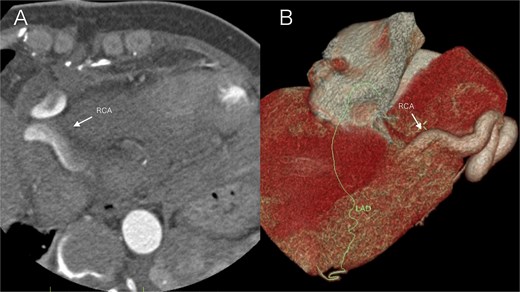 Postoperative imaging on day 5 after surgical repair of a right coronary artery fistula with giant aneurysm. (A) Axial contrast-enhanced CT image at the level of the aortic root. The right coronary artery (arrow) demonstrates a normalized caliber and wall contour, with complete resolution of the preoperative aneurysmal dilation. (B) Volume-rendered three-dimensional CT reconstruction (anterolateral view). The reconstruction focuses on the course of the right coronary artery (arrow), which exhibits a smooth, uniform, and patent lumen without evidence of the previous aneurysm or fistula.