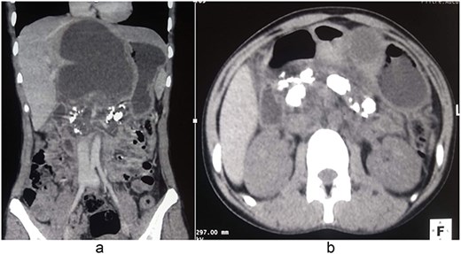 Contrast-enhanced computed tomography showing CCP complicated by a large pancreatic pseudocyst. (a) Coronal reconstruction demonstrating a large pancreatic pseudocyst with associated pancreatic duct calcifications. (b) Axial image showing extensive intraductal pancreatic calcifications consistent with CCP.