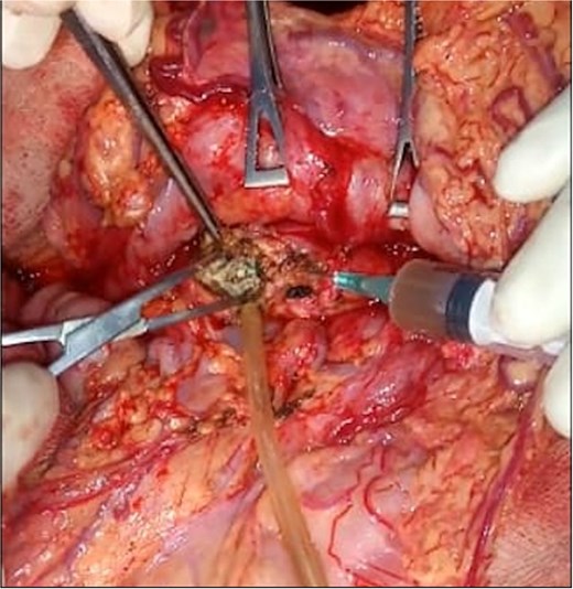 Intraoperative view demonstrating removal of intraductal pancreatic calculi (white arrow) after punction of dilated Wirsung duct and pancreatotomy.