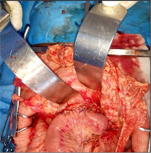 Intraoperative view showing a side-to-side pancreaticojejunostomy performed on a Roux-en-Y limb.