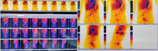 99mTc scintigraphy for detection of Meckel diverticulum.