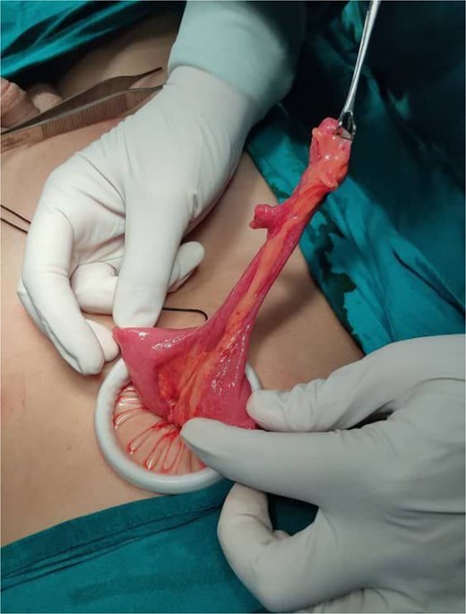 Intraoperative laparoscopic view of MD.