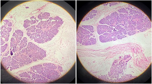 Histopathological examination (H&E stain) of the ectopic pancreatic tissue.