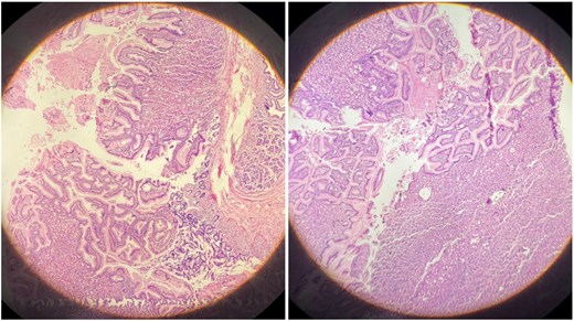 Histopathological examination (H&E stain) of the heterotopic gastric mucosa.