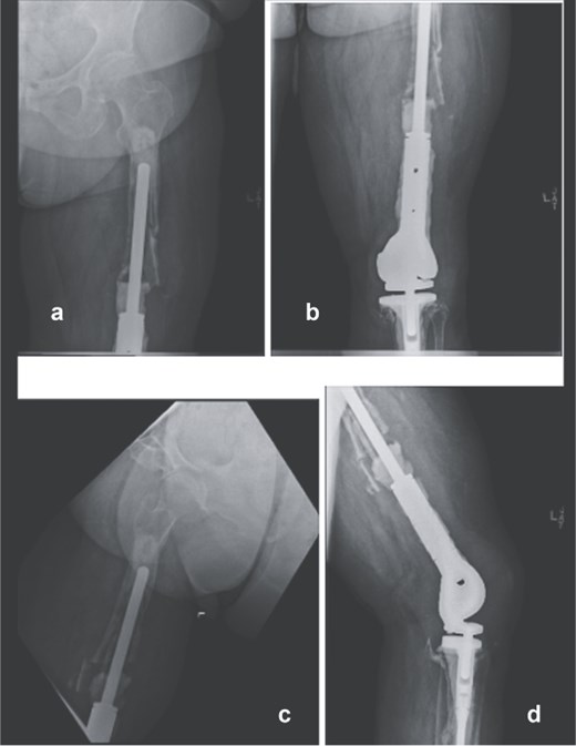 Preoperative anteroposterior (a and b) and lateral radiographs (c and d) of the right femur showing loosening of the proximal femoral stem and extensive proximal femoral bone loss following multiple distal femoral replacement revisions for osteosarcoma.