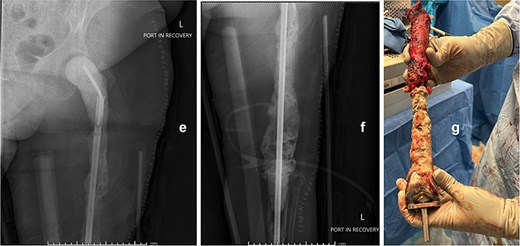 Intraoperative anteroposterior radiographs (e and f) after stage one, demonstrating a custom antibiotic-loaded total femur spacer constructed using an Ilizarov rod embedded in antibiotic cement and a fully cement-coated fusion nail extending from the acetabulum to the tibia. The resected right femoral implant is grossly visualized (g) prior to spacer placement.