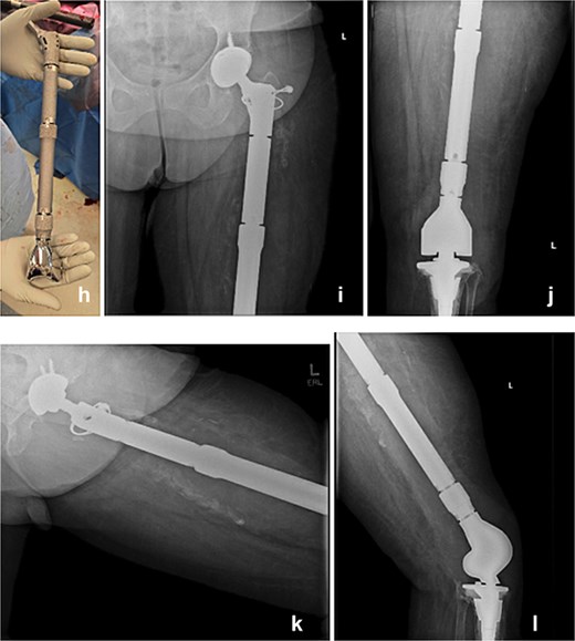 The modular TFR implant (h) is grossly visualized prior to implantation. Immediate postoperative anteroposterior (i and j) and lateral (k and l) radiograph following definitive reimplantation, showing the modular total femur replacement with a dual mobility acetabular component proximally and a rotating-hinge knee mechanism distally in appropriate alignment.