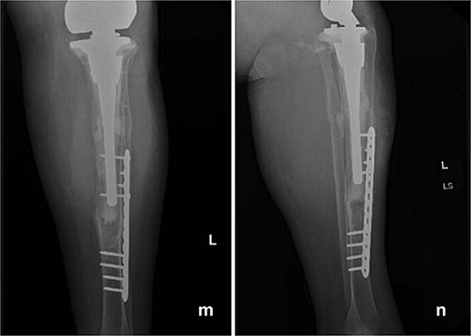 Follow-up anteroposterior (m) and lateral (n) radiographs at 1 year demonstrating intact tibial fixation following fracture repair and a stable total femur construct without evidence of loosening or reinfection.
