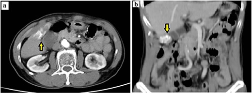 Preoperative contrast-enhanced CT demonstrating a calcified gallbladder fundus lesion suspicious for malignancy. (a) Axial CT shows a calcified mass at the gallbladder fundus with adjacent wall thickening (arrow). (b) Coronal CT reconstruction highlights the calcified lesion involving the gallbladder wall (arrow).