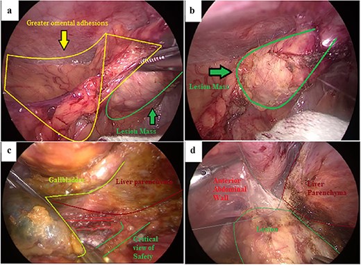 Intraoperative laparoscopic findings during cholecystectomy. (a) Dense inflammatory adhesions involving the greater omentum with an associated lesion mass at the gallbladder fundus. (b) Close-up view of the firm lesion mass at the fundus (outlined). (c) Dissection along the gallbladder–liver interface to obtain the critical view of safety. (d) Calcified lesion adherent to the anterior abdominal wall near the liver margin, excised en bloc with the gallbladder.