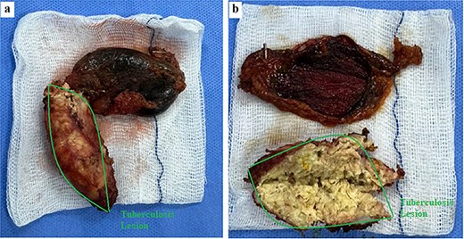 Gross specimen of the gallbladder with tuberculous calcified lesion. (a) Resected gallbladder with a hard calcified structure continuous with the fundus (outlined). (b) Sectioned specimen showing thick whitish caseous-like material within the lesion, consistent with caseating granulomatous inflammation.