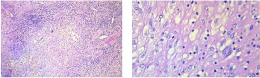 Typical tuberculous granuloma with central caseous necrosis surrounded by epithelioid histiocytes and Langhans-type giant cells.
