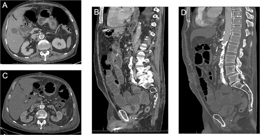 (A–B) Axial and coronal CT images showing the diseased celiac and SMA with flow at POD #10. (C–D) Axial and coronal CT images showing the diseased SMA with a new occlusive thrombus at POD #12.