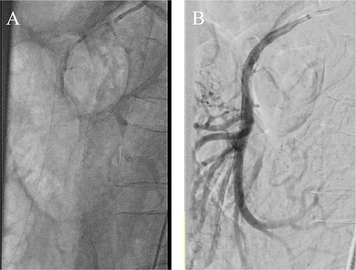 (A) Aortogram with wire passed through the SMA and (B) completion angiogram after stent placement.