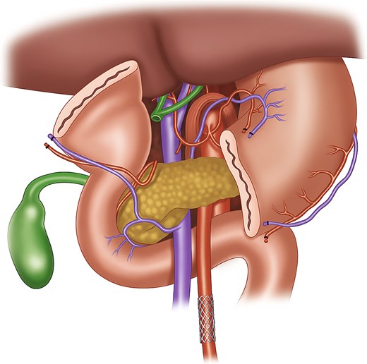 Illustration of stent in the SMA after division of the stomach for better visualization. This figure depicts the anatomy prior to Whipple resection. The stent is also more distal than our ostial lesion for better visualization purposes.