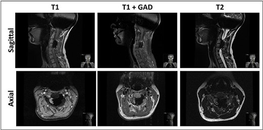 MRI sagittal and axial views of the cervical spine demonstrating non-enhancing, hypointense in all sequences, calcified lesion involving mainly C3–C4, causing severe compression of the spinal cord with hyperintense signal, indicating myelomalacia.