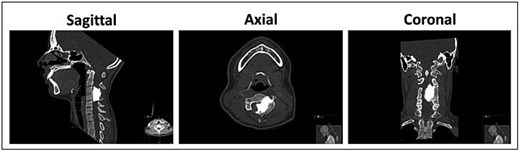 Pre-operative CT scan of the cervical spine demonstrating dense cortical hyperostotic lesion along the anterior and posterior elements of C3–C4 with classic “dripping candle wax” morphology, indicative of melorheostosis.