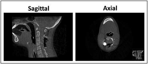 Post-operative CT scan of the cervical spine demonstrating post-operative adequate decompression and alignment, with canal dimensions increasing from a minimal preoperative size of 4.7 × 12.1 mm (Anterior-Posterior*BiLateral) to 27.3 × 17.7 mm at the level of upper 1/4 of C4.