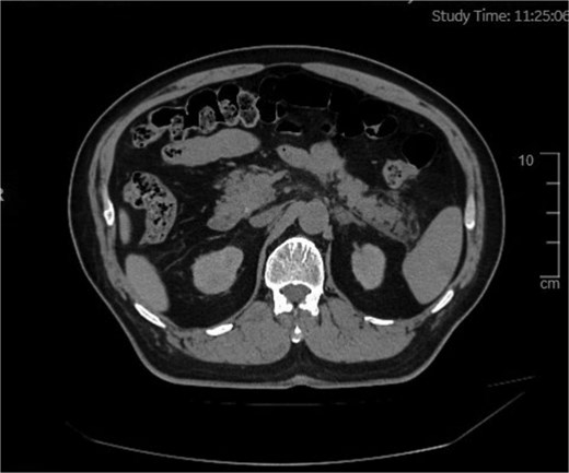 Abdominal scan showing an area of exudative changes within the tail of the pancreas (Balthazar grade B).