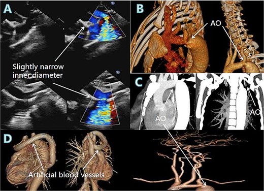 Coloured blood flow signals from the descending aortic arch (A, arrow), 3D reconstruction and chest CT showing the area of aortic stenosis (B, C, arrows), postoperative 3D reconstruction showing the artificial vessel and the success of the procedure (D, arrow).
