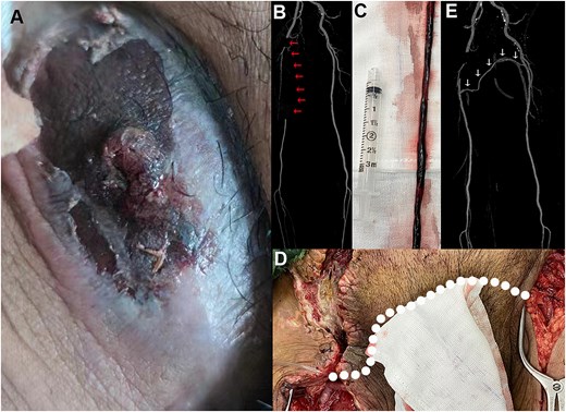 Representative images of femoral artery pseudoaneurysm. (A) A preoperative pulsatile hematoma in the right groin. (B) CT image with the red arrows pointing to the obstructive superficial femoral artery. (C) The removed arterial thrombosis. (D) Intraoperative bypass of left-to-right femoral artery; white dashed line showing the autologous vein trajectory. (E) Postoperative computed tomography angiography image showing the autologous vessel (white arrows) and the right extremity demonstrating patent arterial flow.