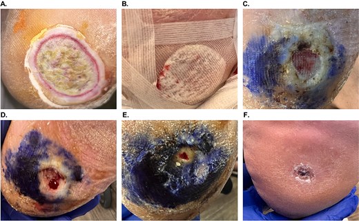 Patient #4 (left plantar heel Wagner 2 DFU) healing progression. (A) Initial presentation. (B) OFM-HA application and dressing. (C) Week 2 post-OFM-HA application, with fully integrated OFM-HA and reduced wound size. (D) Week 3 post-OFM-HA application and second sharp debridement. (E) Week 6 post-OFM-HA application and third sharp debridement, with further significant reduction in wound size. (F) Long-term follow-up, 5 months post-OFM-HA application.