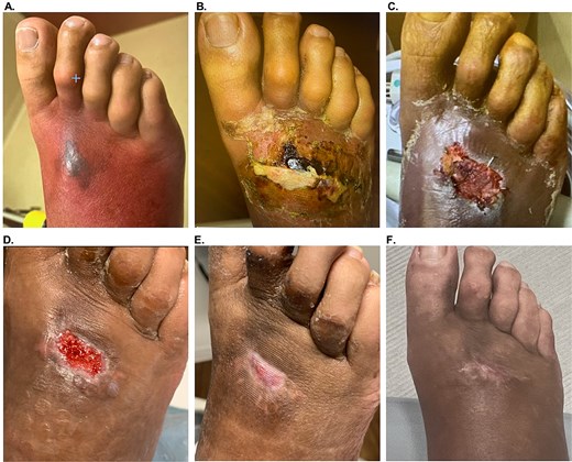 Patient #8 (right foot Wagner 3 DFU/NSTI) healing progression. (A). Initial presentation. (B) After incision and drainage, day of 3-layer OFM and OFM particulate application. (C) 1 week after application, with OFM matrix and particulate starting to integrate. (D) 4 weeks after OFM matrix and particulate application, with a fully vascularized wound bed, day of OFM-HA application. (E) 4 weeks post-OFM-HA application, with full closure. (F) Long-term follow-up, 11 weeks post-OFM-HA application.