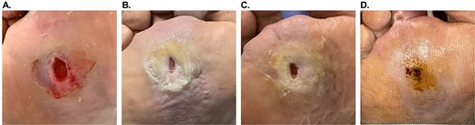 Patient #10 (right plantar region Wagner 2 DFU) healing progression. (A). Initial presentation, after debridement. (B). 1 week after the first OFM-HA application. (C) 4 weeks after the first OFM-HA application, day of the third application. (D) 10 weeks after the first OFM-HA application, full closure.