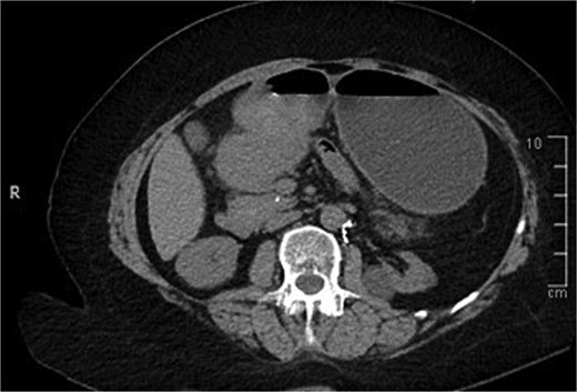Contrast-enhanced CT of the abdomen. Axial view showing gastric outlet obstruction.