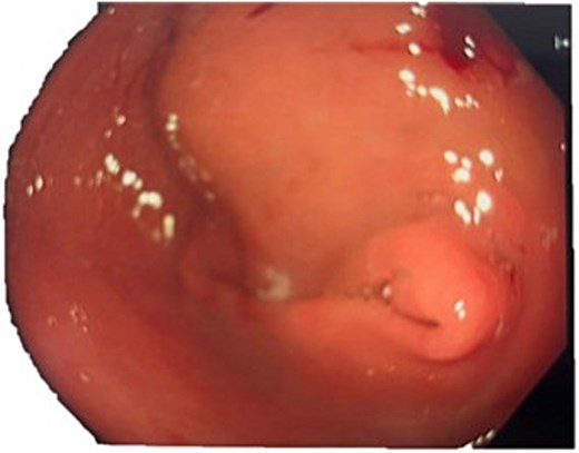 Endoscopic photograph showing large partially obstructing extraluminal mass at the gastric antrum.