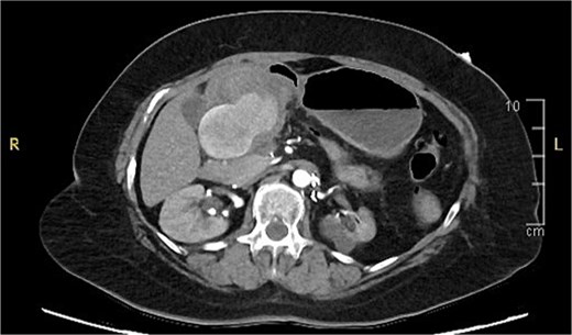 Contrast-enhanced CT angiography of the abdomen. Axial view showing a large 6.2 × 4.2 × 7.0 cm pseudoaneurysm arising from the gastroduodenal artery.