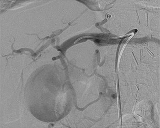 Intraoperative photograph of successful coil angioembolization of the pseudoaneurysm.