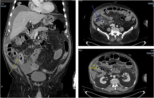 Arrows pointing towards areas of bowel wall defect.