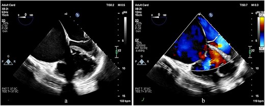 TEE images at the mid-esophageal level, four-chamber view, obtained with clockwise rotation focusing on the right heart. (a, b) The images demonstrate severe RV and RA enlargement, dilated tricuspid annulus, and functional TR. Note the leftward shifting of the interatrial septum toward the LA cavity, consistent with elevated RA pressure.