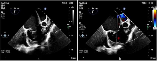 TEE images focusing on the RVOT and PV. (a, b) The images show doming of the PV, a prominent muscular bundle beneath the PV, and supravalvular narrowing, resulting in flow acceleration across all these levels.