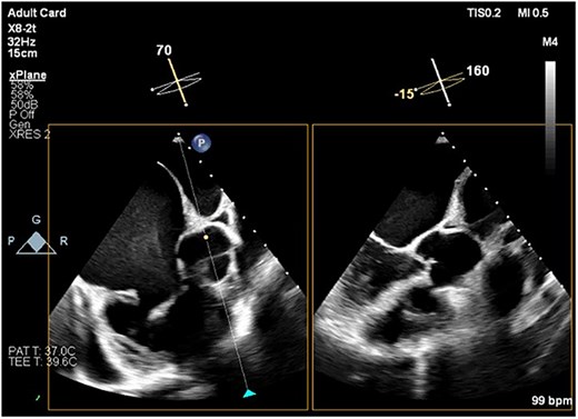 TEE image showing the short-axis view of the aortic valve and the corresponding long-axis view of the LV. There is no evidence of aortic overriding or septal defect. Note the spontaneous echo contrast smoke, representing slow blood flow, observed in the RA cavity.