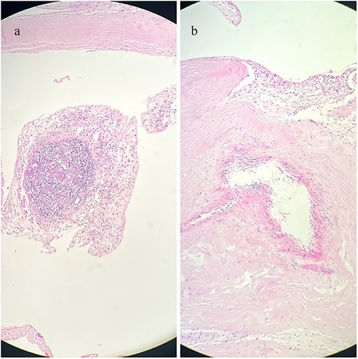 Histopathological sections of the pericardial biopsy stained with haematoxylin and eosin (H&E). (a) Dense granulation tissue with inflammatory cell infiltration. (b) Chronic fibrosing pericarditis characterized by thickened fibrous tissue. Scale bar not available.