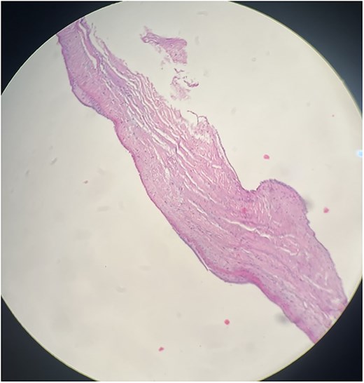 Histopathological section of PV biopsy stained with haematoxylin and eosin (H&E). The section shows degenerative fibrohyalinized valvulopathy of the PV. Scale bar not available.