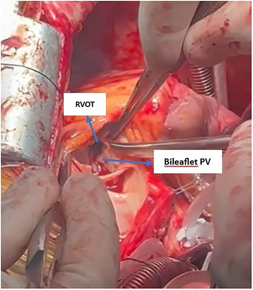 Intraoperative view showing the subvalvular RVOT with a bileaflet pulmonary valve. Severe obstruction at the RVOT is evident, indicated by narrowing below the valve leaflets.