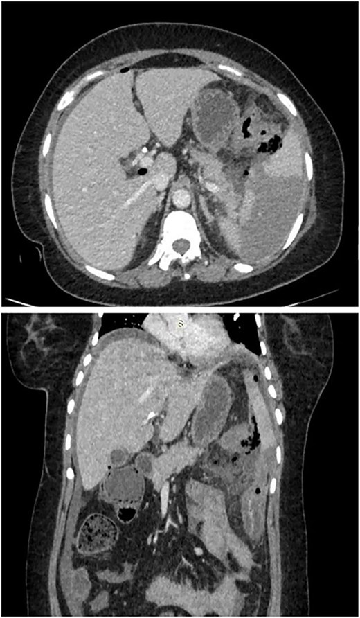 CT scan of abdomen showed pneumoperitoneum in inter bowel space, pancreatic necrosis, peripancreatic collection in splenic flexure region with multiple air foci within it and adjacent mesenteric fat stranding and heterogeneity. (? Splenic flexure of colon perforation).
