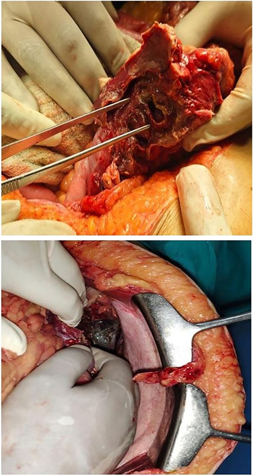 2 × 1 cm splenic flexure of colon perforation & necrotic pancreas.
