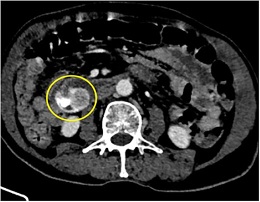 88Y/M with 2 episodes of black tarry stool, axial view of the contrast-enhanced computed tomography (CECT) abdomen showing a heterogenous mass with extravasation of contrast material, signifying the source of hemorrhage.