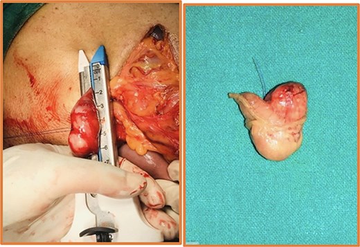 Intraoperative (left) and postoperative resected specimen (right) of 72Y/M with asymptomatic, incidental duodenal GIST.