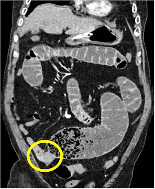 75Y/M with upper abdominal pain, vomiting, abdominal distention, coronal view of the CECT abdomen showing intraluminal mass in the distal jejunum, causing dilatation of the bowel proximall.