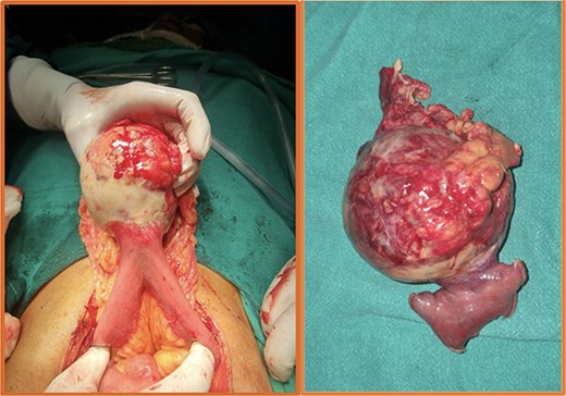 Intraoperative (left) and postoperative resected specimen (right) of a 70/female with bleeding jejunal GIST underwent open segmental resection of jejunal GIST with end to end jejunojejunal anastomosis.