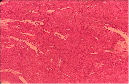 Histopathological slide of the resected specimen of 55Y/M with jejunal GIST.