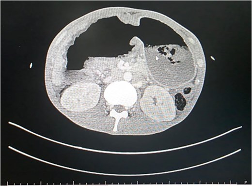 CECT scan showing non-enhancement of distal stomach.